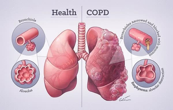 Bệnh phổi tắc nghẽn mạn tính (COPD): Nguyên nhân và triệu chứng cần lưu ý