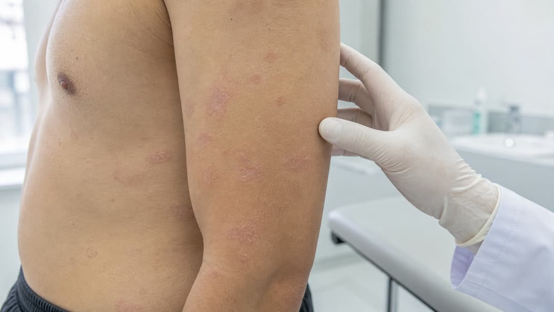 Á vảy nến là gì? Dấu hiệu, chẩn đoán và cách theo dõi