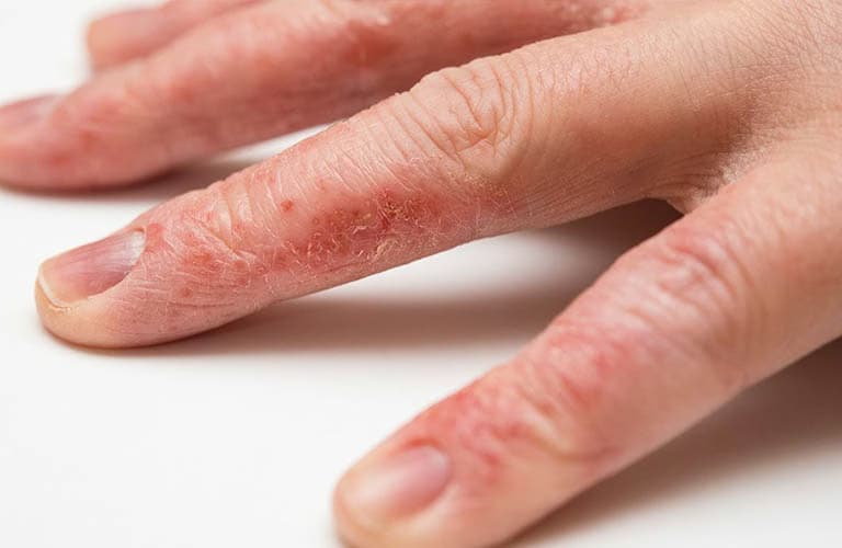 Bệnh á sừng: Nguyên nhân, triệu chứng và cách kiểm soát