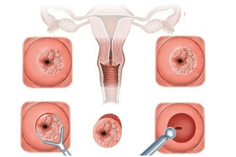 Viêm cổ tử cung: Nguyên nhân, dấu hiệu và cách điều trị