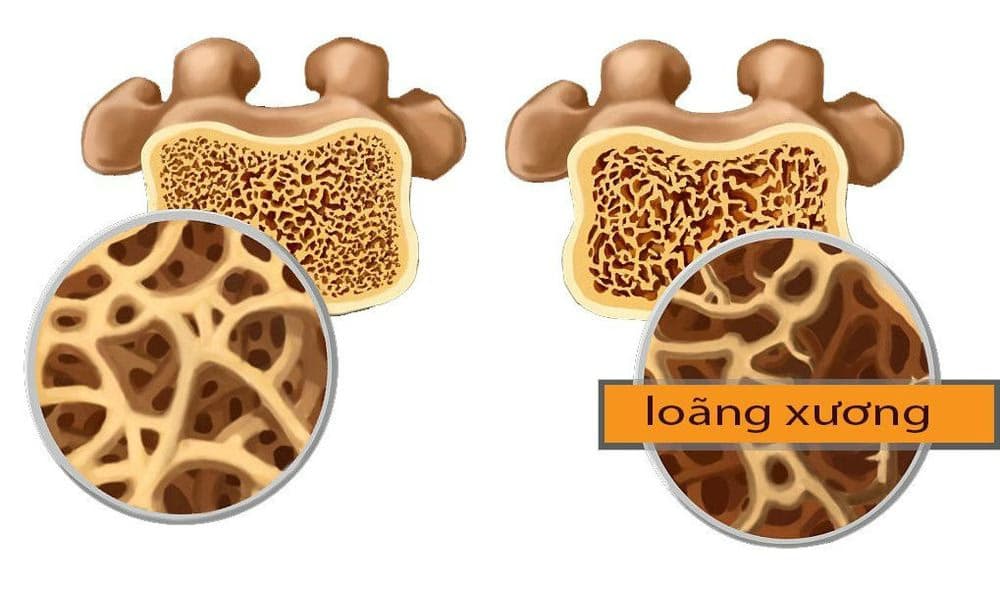 Gãy cổ xương đùi: Nguyên nhân, dấu hiệu và cách điều trị