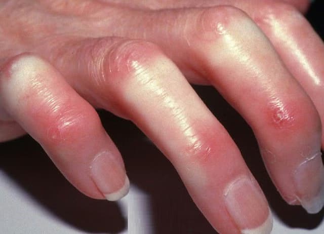 Bệnh xơ cứng bì: Dấu hiệu, nguyên nhân và cách kiểm soát