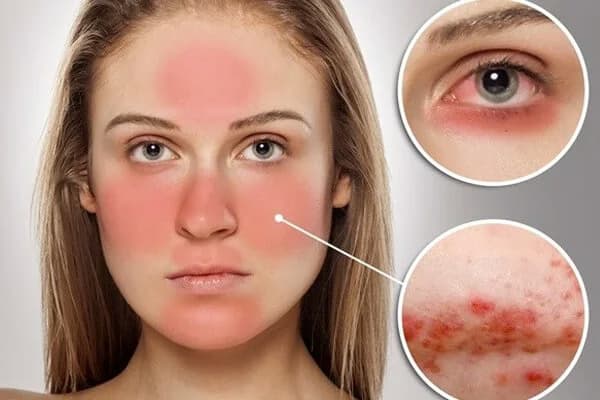 Lupus ban đỏ hệ thống: Nguyên nhân, triệu chứng và cách điều trị