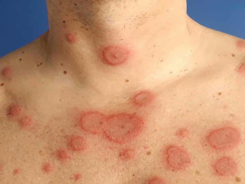 Lupus ban đỏ hệ thống gây tổn thương thận: Dấu hiệu, nguyên nhân và cách quản lý