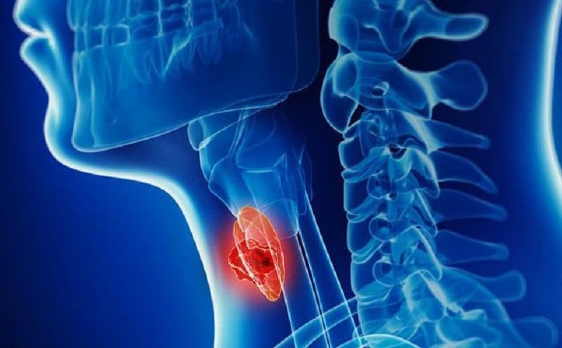Ung thư hạ họng: Dấu hiệu, nguyên nhân và các cách điều trị