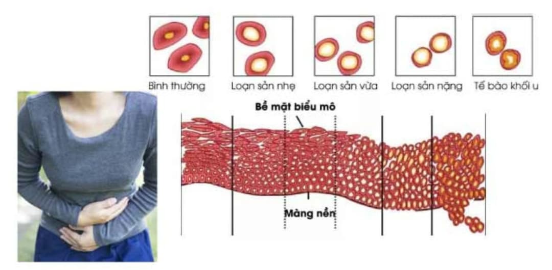Loạn sản cổ tử cung: Dấu hiệu, phân độ tổn thương và cách điều trị