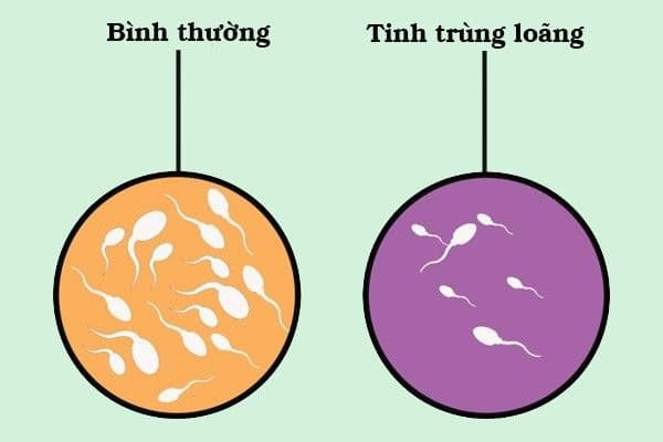Tinh trùng loãng: Nguyên nhân, dấu hiệu và cách điều trị