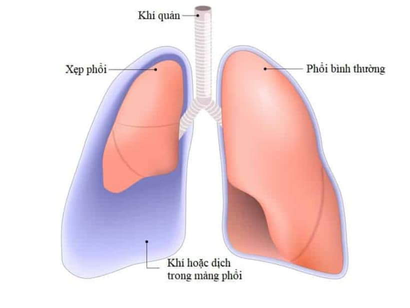 Xẹp phổi: Nguyên nhân, triệu chứng và các phương pháp phục hồi