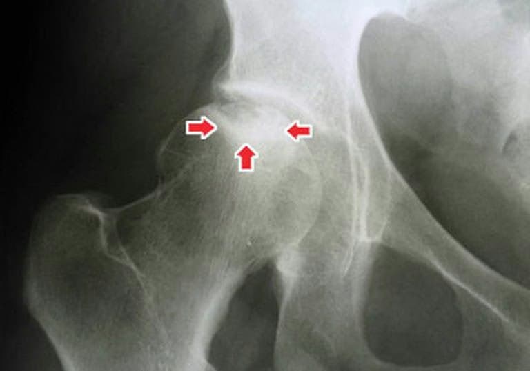 Hẹp khe khớp háng: Nguyên nhân, dấu hiệu và cách điều trị