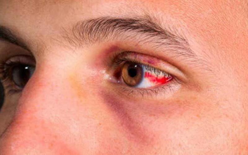 Bệnh hắc võng mạc trung tâm: Nguyên nhân, dấu hiệu và cách xử trí