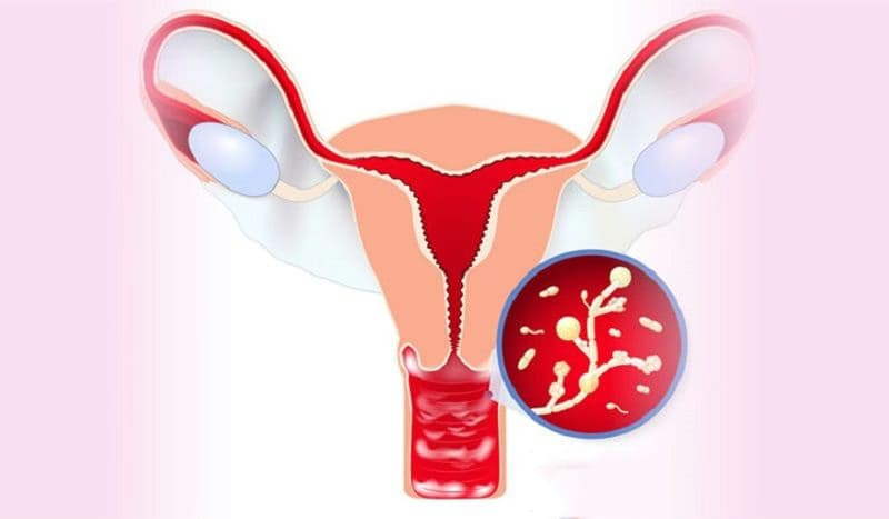 Bệnh viêm vùng chậu: Nguyên nhân, dấu hiệu và cách điều trị