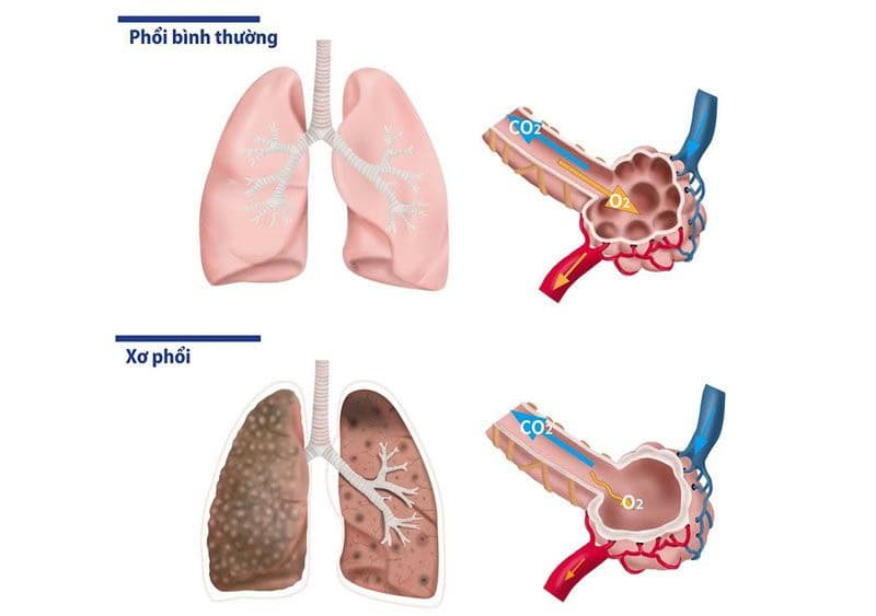 Bệnh xơ phổi: Nguyên nhân, triệu chứng và cách điều trị kiểm soát bệnh