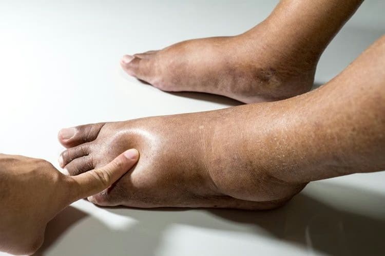 Phù chân: Nguyên nhân, dấu hiệu và cách xử trí