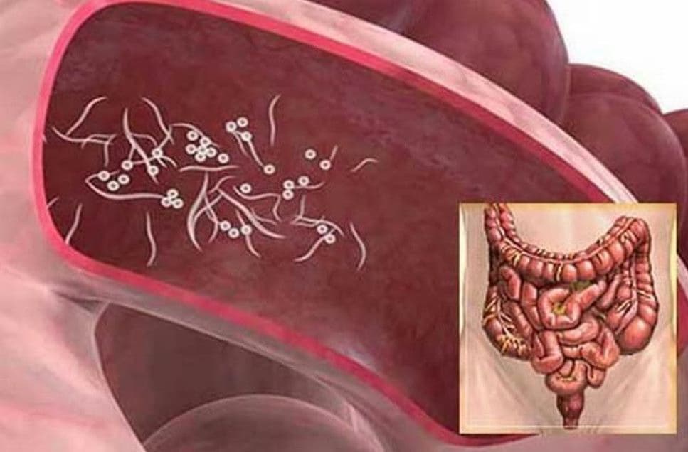 Bệnh giun sán: Nguyên nhân, dấu hiệu, biến chứng và cách điều trị