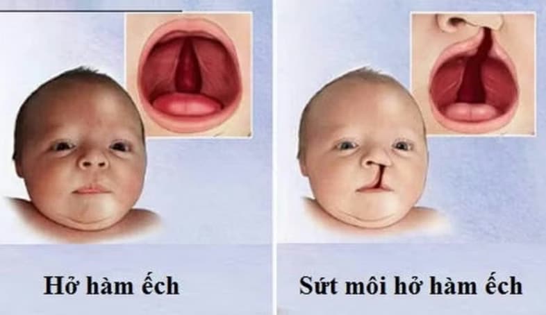 Sứt môi và hở hàm ếch: Nguyên nhân, dấu hiệu và cách điều trị