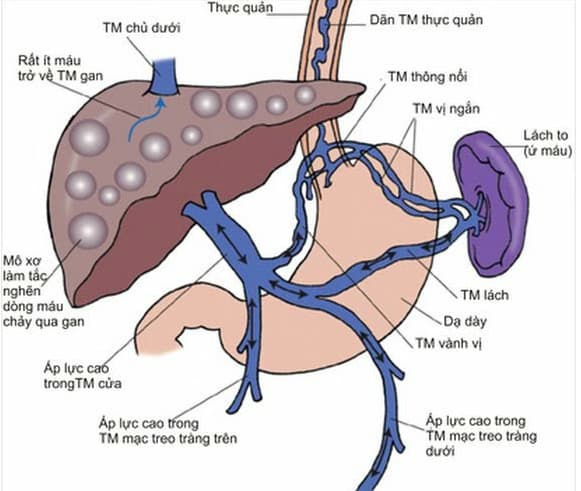 Tăng áp tĩnh mạch cửa: Nguyên nhân, dấu hiệu và cách điều trị