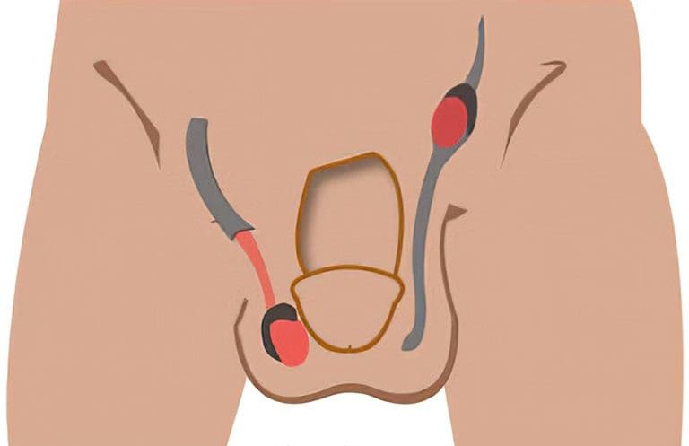 Tinh hoàn lạc chỗ: Nguyên nhân, dấu hiệu và cách điều trị