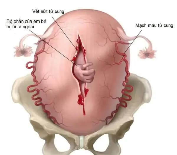 Vỡ tử cung: Dấu hiệu, nguyên nhân và xử trí cấp cứu