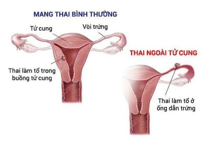 Thai ngoài tử cung: Dấu hiệu sớm, nguyên nhân và cách xử trí