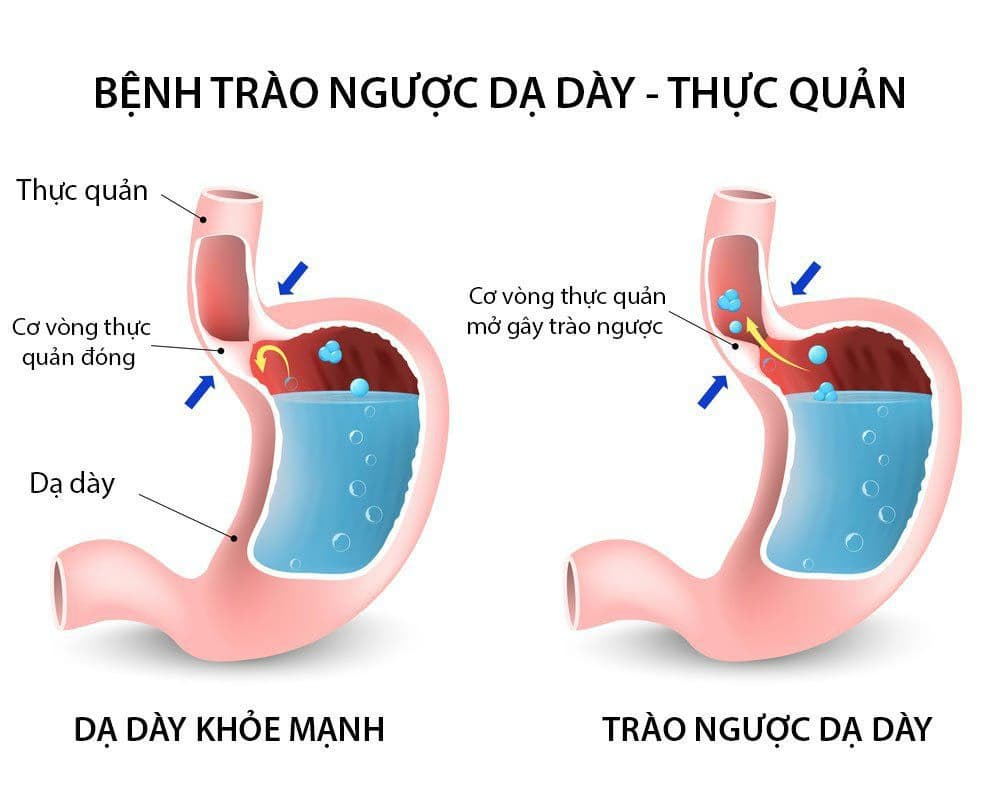 Ợ chua: Dấu hiệu, nguyên nhân và các phương pháp kiểm soát