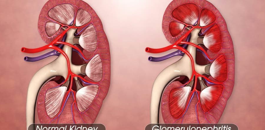 Bệnh cầu thận: Nguyên nhân, dấu hiệu, biến chứng và chẩn đoán