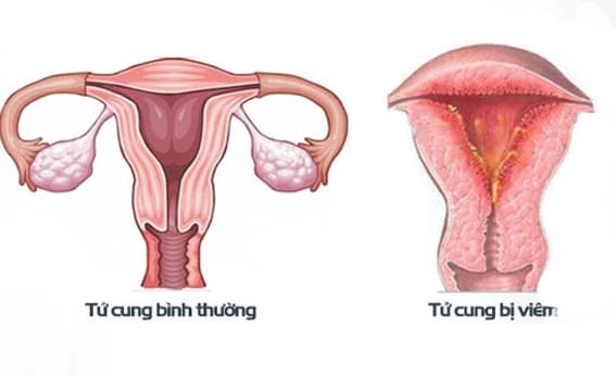 Viêm nội mạc tử cung: Nguyên nhân, triệu chứng và nguyên tắc điều trị