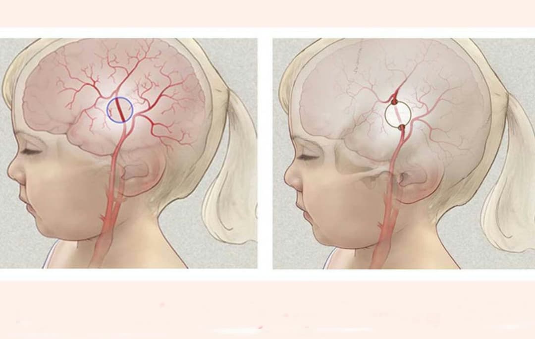 Bệnh Moyamoya: Nguyên nhân, dấu hiệu và cách điều trị