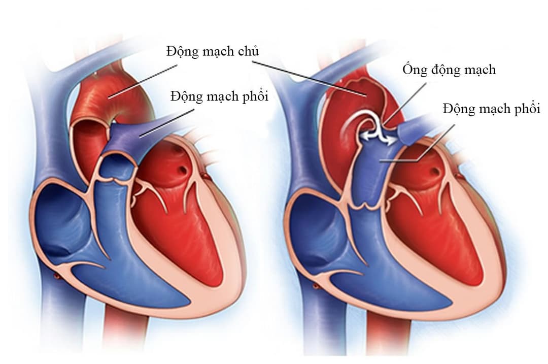 Còn ống động mạch: Nguyên nhân, triệu chứng, biến chứng và chẩn đoán