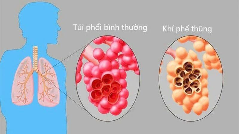 Khí phế thũng: Cơ chế tổn thương phế nang, nhận biết triệu chứng và cách điều trị