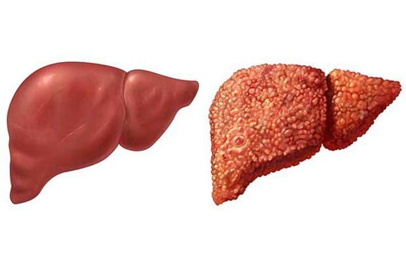 Xơ gan mất bù: Dấu hiệu, nguyên nhân, biến chứng và cách điều trị