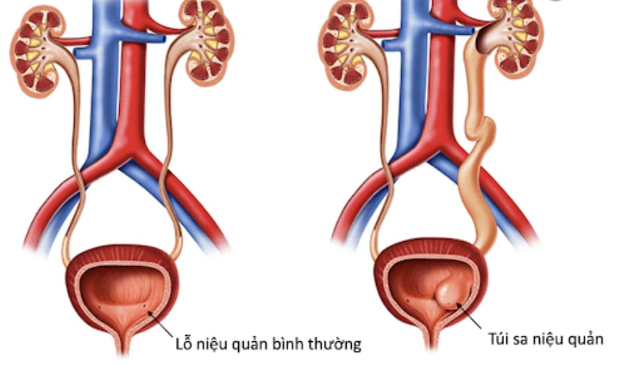 Nang niệu quản: Dấu hiệu, biến chứng và cách điều trị