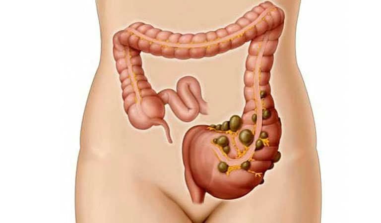 Viêm túi thừa đại tràng: Chẩn đoán và cách điều trị
