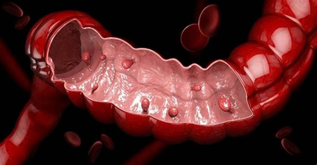Polyp trực tràng: Nguyên nhân, triệu chứng và tầm soát