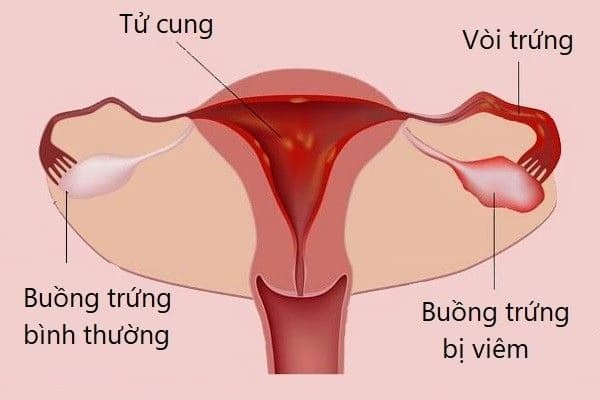 Viêm buồng trứng: Nguyên nhân, dấu hiệu và cách điều trị