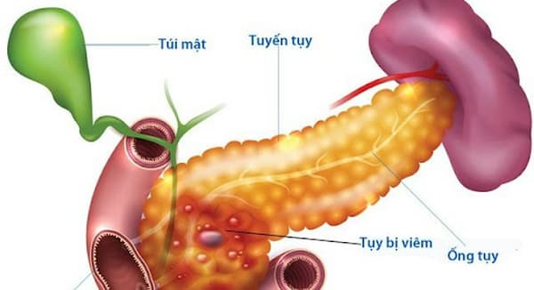 Viêm tụy mạn: Nguyên nhân, dấu hiệu và cách điều trị