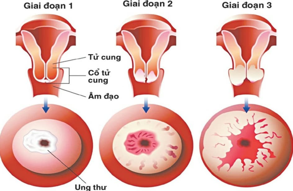 Ung thư cổ tử cung: Dấu hiệu, nguyên nhân và các cách điều trị