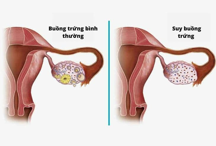 Suy buồng trứng sớm: Dấu hiệu, nguyên nhân và cách quản lý