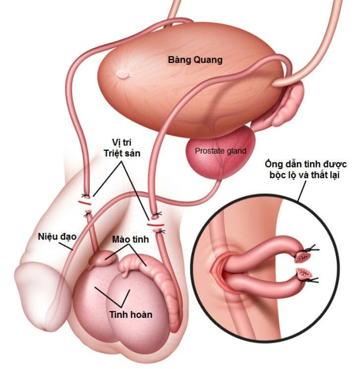 Thắt ống dẫn tinh: Quy trình thực hiện, hiệu quả ngừa thai và những lưu ý