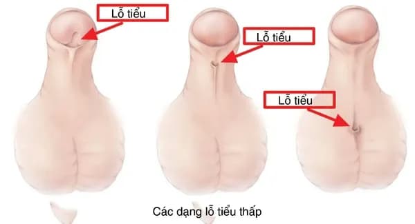 Lỗ tiểu lệch thấp ở trẻ em: Nguyên nhân, dấu hiệu và cách điều trị
