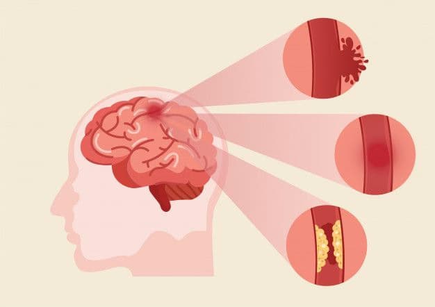 Sa sút trí tuệ do mạch máu não: Nguyên nhân và dấu hiệu