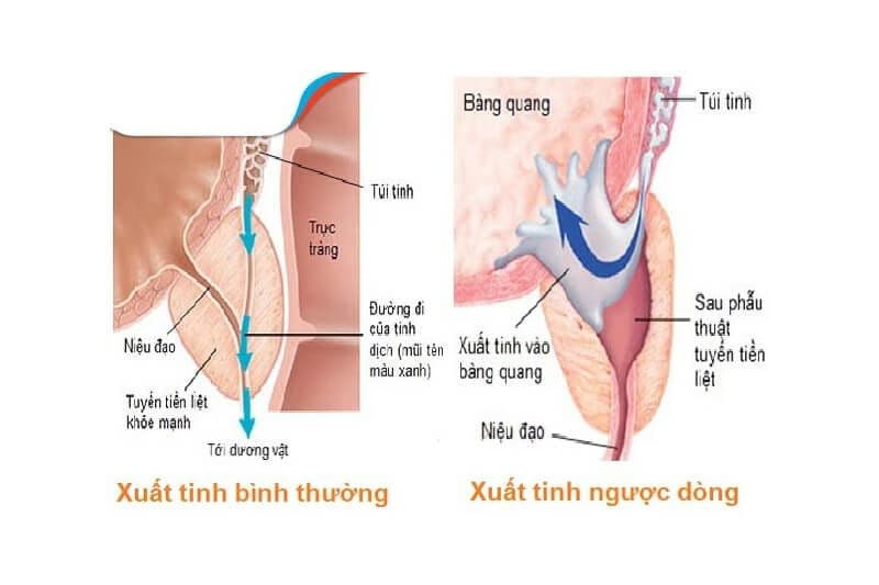 Xuất tinh ngược dòng là gì: Nguyên nhân, triệu chứng và cách xử trí