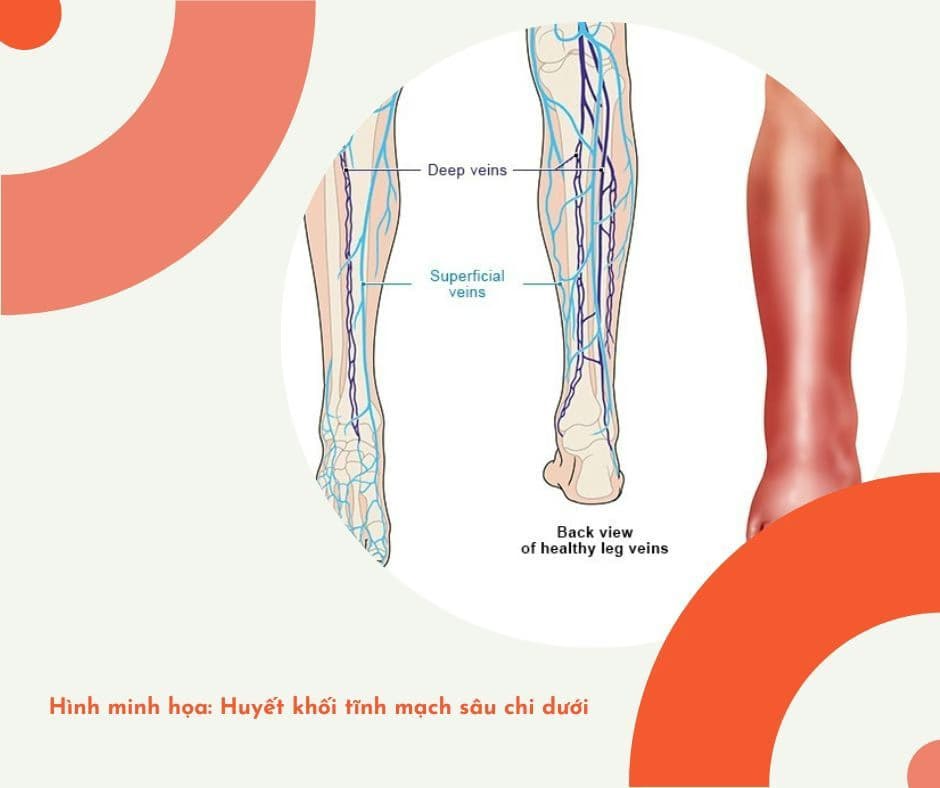 Huyết khối tĩnh mạch sâu chi dưới: Nguyên nhân, triệu chứng và cách điều trị