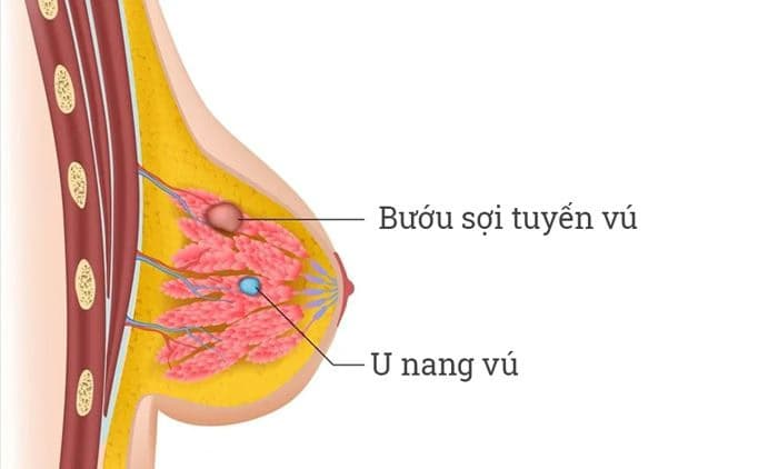 Bướu sợi tuyến BI-RADS 3: Định nghĩa, nguyên nhân, triệu chứng và chẩn đoán