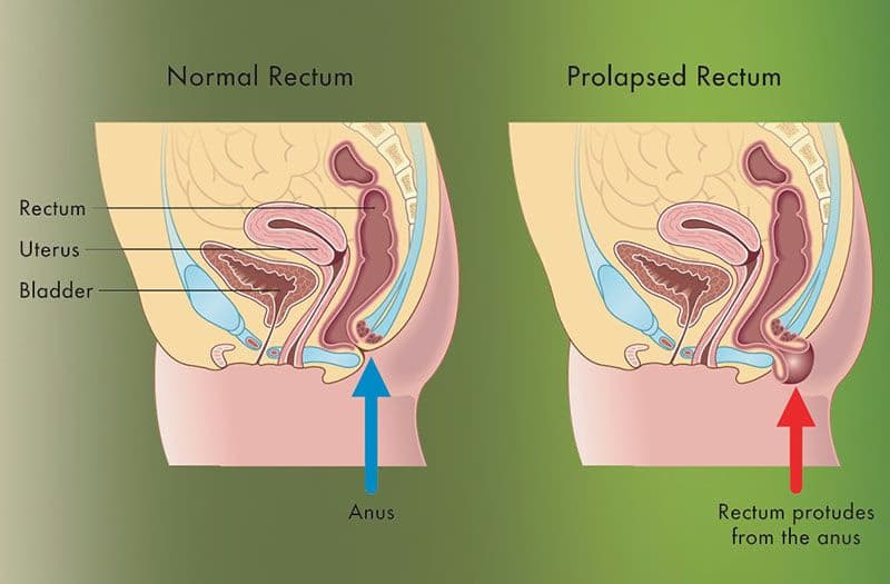 Sa trực tràng: Dấu hiệu, nguyên nhân và các cách điều trị