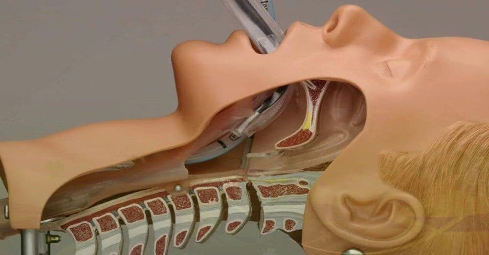 Chấn thương khí quản: Nguyên nhân, dấu hiệu, biến chứng và phương pháp chẩn đoán