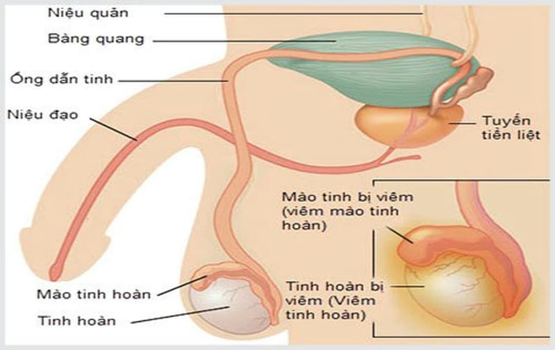 Viêm tinh hoàn: Nguyên nhân, dấu hiệu và cách điều trị