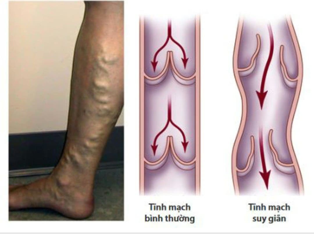 Suy giãn tĩnh mạch: Nguyên nhân, triệu chứng và các phương pháp chẩn đoán