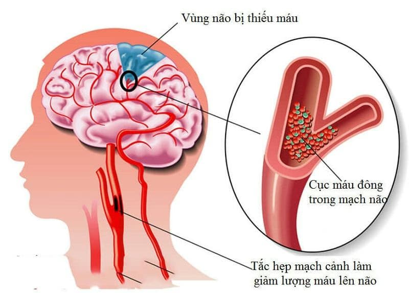 Parkinson thứ phát là gì? Nguyên nhân, dấu hiệu và cách điều trị