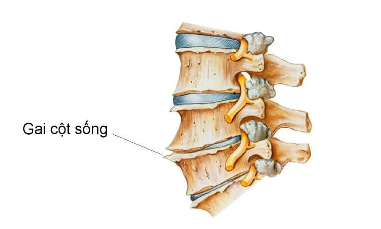 Gai cột sống: Nguyên nhân, dấu hiệu và cách điều trị