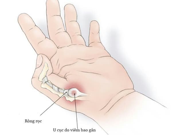 Viêm khớp ngón tay: Dấu hiệu, nguyên nhân và cách kiểm soát